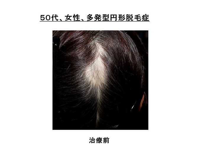 汎発性脱毛　病院